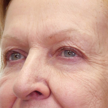 Attenuation and correction of static and dynamic wrinkles